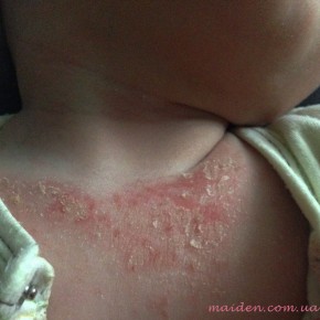 Атопічний дерматит у дітей: купання та догляд за шкірою